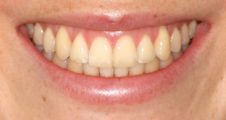 close up of straight teeth after spark aligners