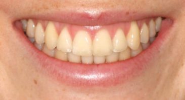 close up of straight teeth after spark aligners