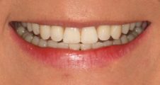 close up view of straight teeth after invisalign treatment