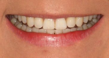 close up view of straight teeth after invisalign treatment