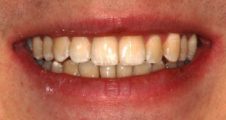 close up of straight teeth after spark aligners