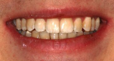 close up of straight teeth after spark aligners