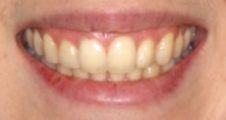 After - Angus Pringle Orthodontics