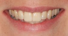 close up of straight teeth after spark aligners