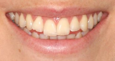 Before - Angus Pringle Orthodontics
