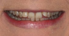 close up view of crooked teeth before invisalign