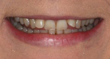 close up view of crooked teeth before invisalign