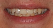 close up of crooked twisted teeth before spark aligners