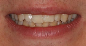 close up of crooked twisted teeth before spark aligners