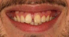 close up of gappy teeth prior to Invisalign