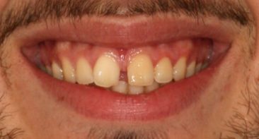 close up of gappy teeth prior to Invisalign