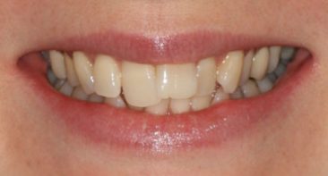 close up of crooked teeth prior to spark aligners