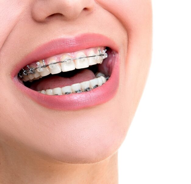 damon braces, clear ceramic fixed braces and metal fixed braces