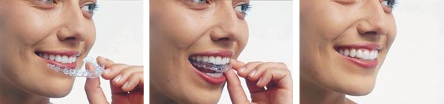 Invisalign Fareham WInchester