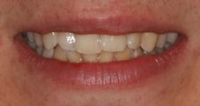Before Invisalign – anterior crossbite affecting alignment