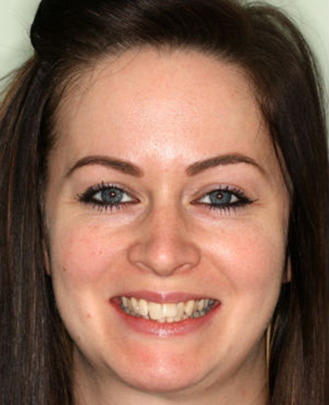Before Invisalign treatment – adult patient with dental crowding in Fareham