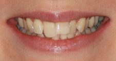Before Invisalign – adult dental crowding and misalignment