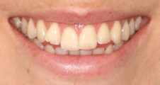 Before Invisalign – mild crowding and anterior open bite