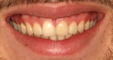 After Invisalign – diastema closed and improved alignment