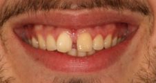 Before Invisalign – upper front tooth diastema