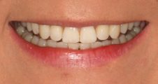 After Invisalign – corrected lateral incisor position