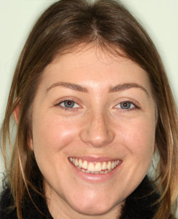 Before Invisalign treatment – adult female with mild crowding and slight open bite in Fareham