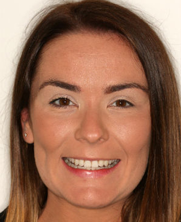 After Invisalign – improved smile symmetry and balanced front teeth