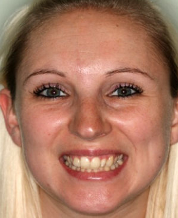 Before Invisalign – adult female with rotated upper front tooth