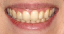 After Invisalign – corrected tooth rotation and alignment