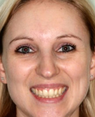 After Invisalign – straightened front tooth and improved smile