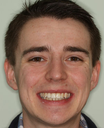 After Invisalign – corrected crossed teeth and balanced smile