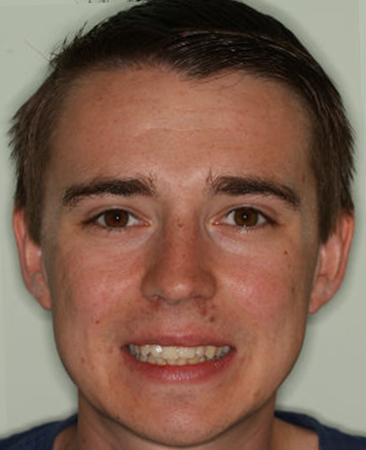 Before Invisalign – adult male with crossed front teeth