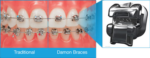 picture showing the difference between traditional fixed brace and newwer damon self ligating braces