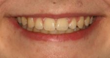teenager after treatment with damon braces to straighten teeth, close gaps and reduce protruding teeth