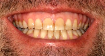 close up adult with straight teeth and corrected bite after damon braces