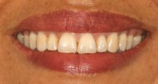 adult straight teeth after spark aligners