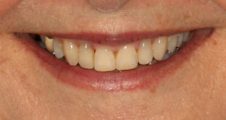 close up adult with straight teeth and broad smile after damon braces