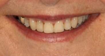 close up adult with straight teeth and broad smile after damon braces