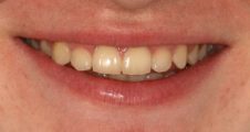 close up of teenager after treatment with straighten teeth and good bite treated with damon braces