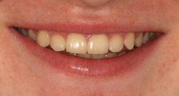 close up of teenager after treatment with straighten teeth and good bite treated with damon braces