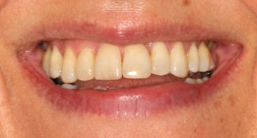 close up of adult after treatment to straighten teeth and improve bite treated with damon braces