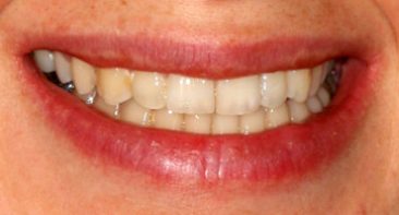 close up of adult after treatment with straighter and whiter teeth treated with Invisalign