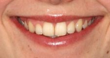 adult straight teeth after damon braces