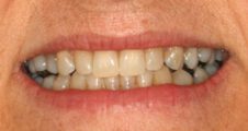 close up adult gaps closed straight teeth after invisalign