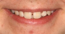 close up of teenager with gaps between her teeth and protruding teeth