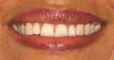 close up adult crooked teeth prior to spark aligners