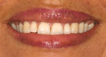 close up adult crooked teeth prior to spark aligners