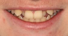 close up of teenager with crooked overlapping teeth prior to damon braces