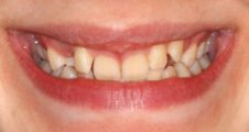 close of teenager with crooked teeth and tilted teeth prior to damon braces