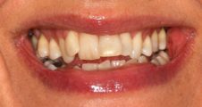 close up of adult prior to treatment with wonky teeth prior to damon braces